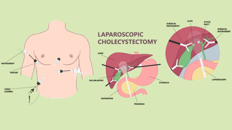 Laparoscopic Liver Surgery