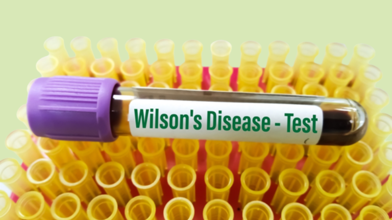 Wilson's disease test