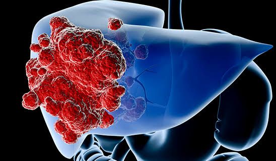 Liver Cancer Treatment In Mumbai: Expanding Transplant Options and Improving Survival Rates