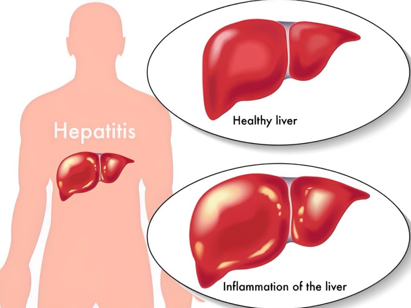 How Inflammation Affects the Liver -Hepatitis